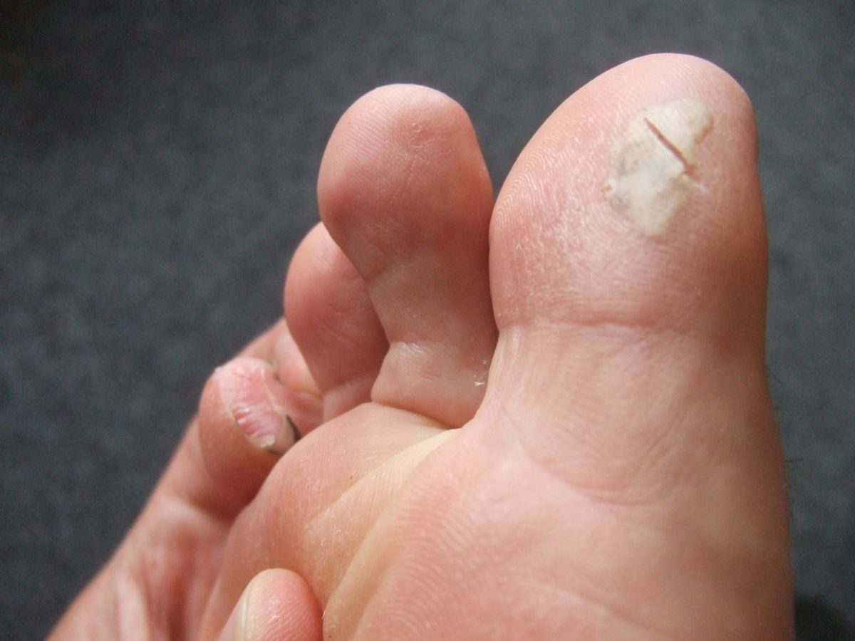 Tips to Prevent Blisters while Hiking – Being a Professional Hiker